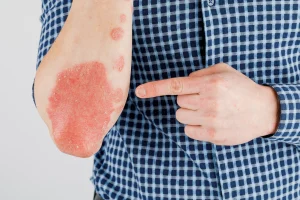 Skin diseases treatment