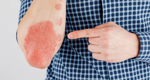 Skin diseases treatment