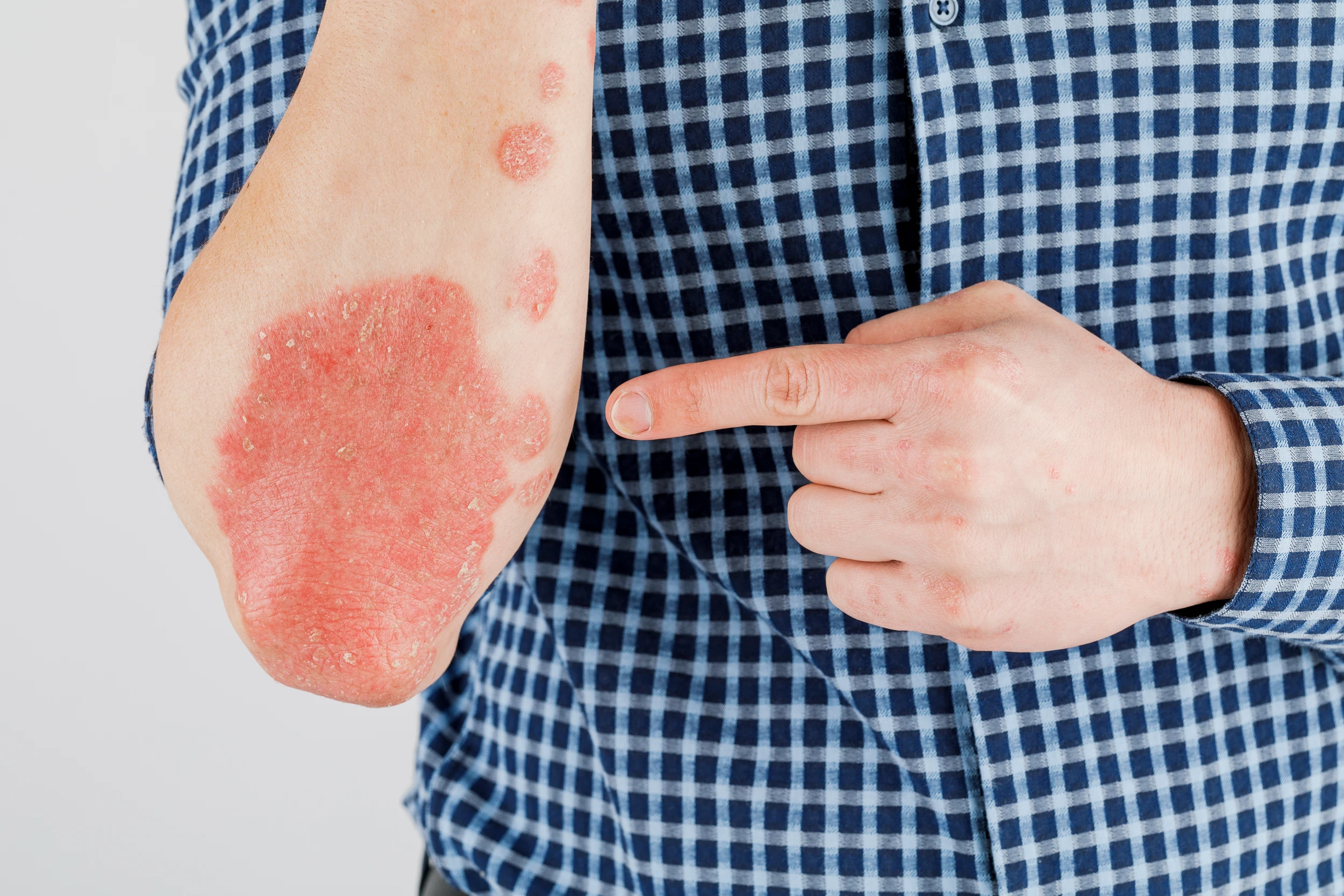 Skin diseases treatment